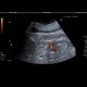 Arteriovenous malformation of kidney: US - Ultrasound
